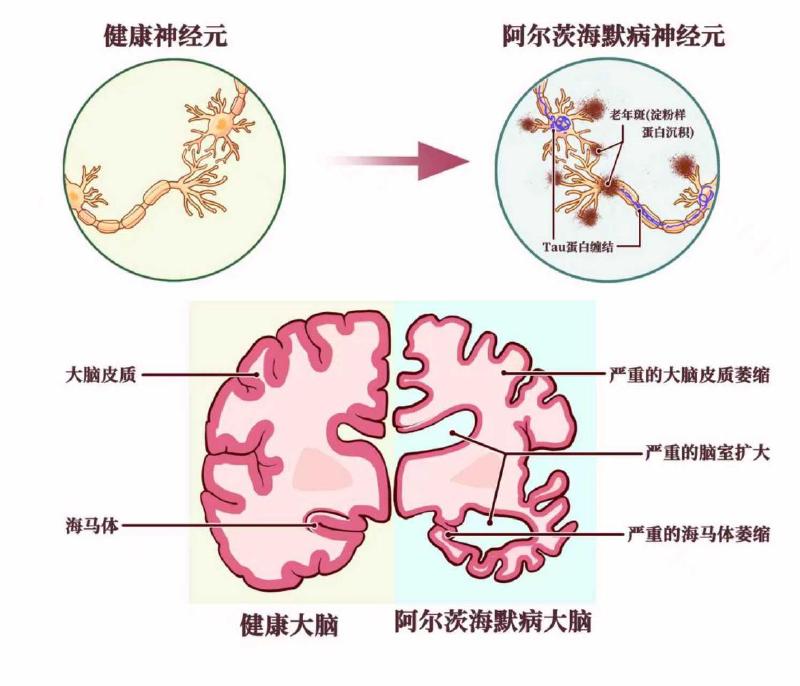 阿尔茨海默病大脑和神经元改变